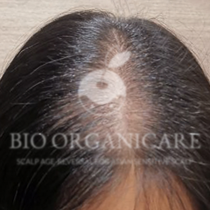 Premature Hair Loss - Before (Hair Loss)