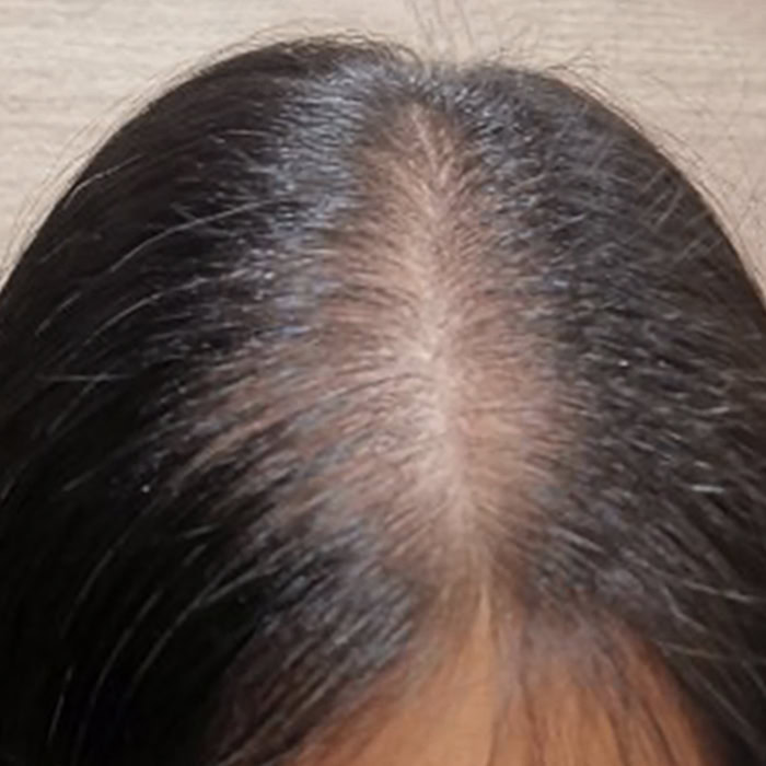 Premature Hair Loss - Before