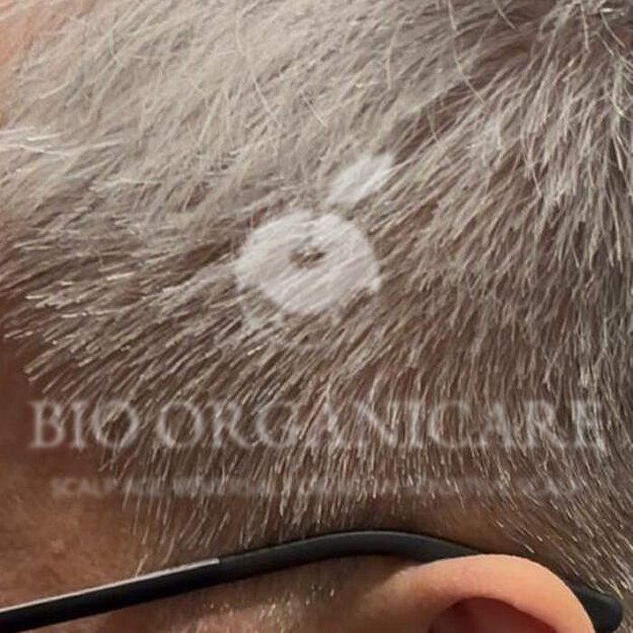 Scalp Disorder - After (Advanced Cases)