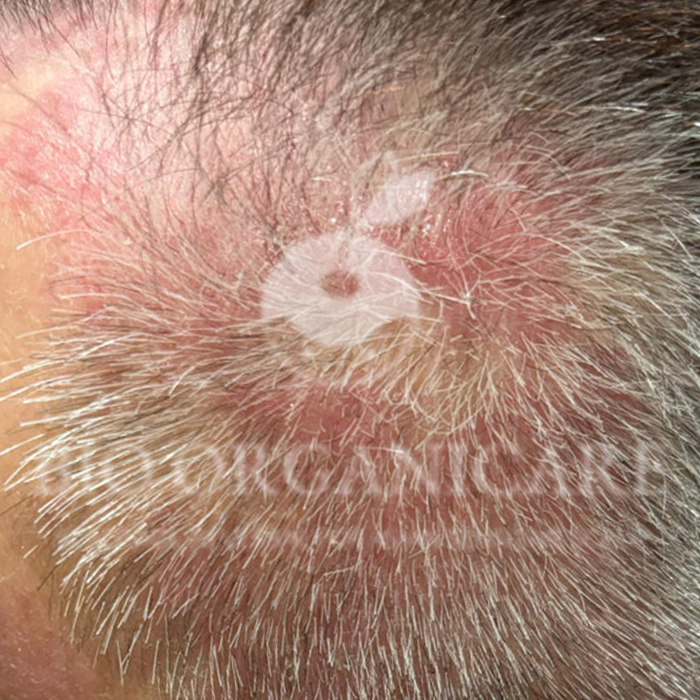 Scalp Disorder - Before (Advanced Cases)