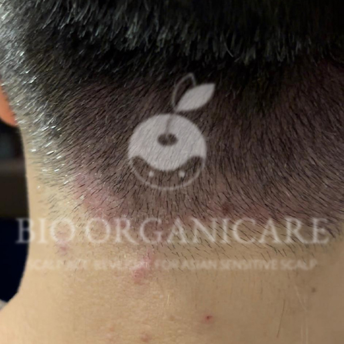 Sensitive Scalp - Before (Dandruff _ Oily Scalp _ Sensitive)