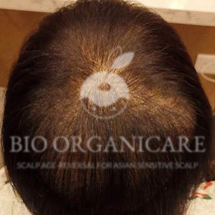 Stress Hair Loss - After (Hair Loss)