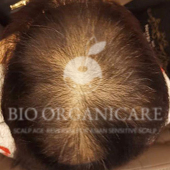 Stress Hair Loss - Before (Hair Loss)