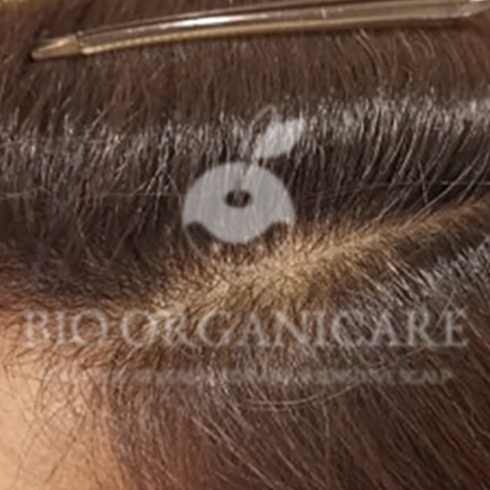 Traction Alopecia - After (Advanced Cases)