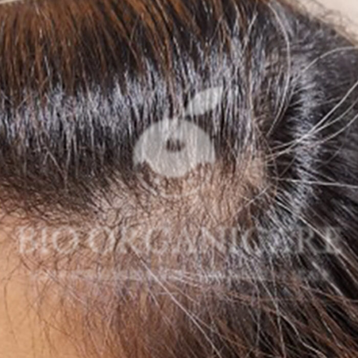 Traction Alopecia - Before (Advanced Cases)