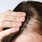 Close-up of a woman checking her thinning hair scalp