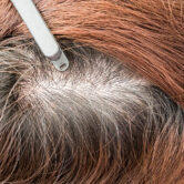 Close-up of a female scalp showing visible hair thinning.