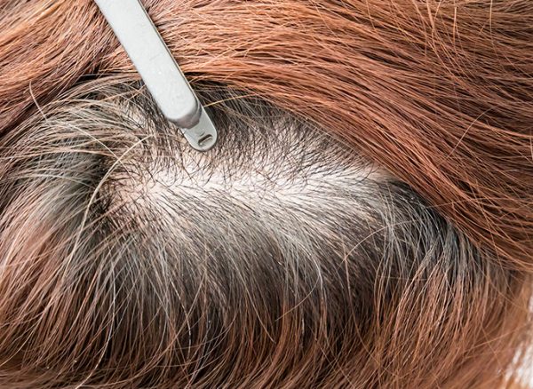 Close-up of a female scalp showing visible hair thinning.