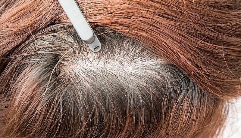 Close-up of a female scalp showing visible hair thinning.