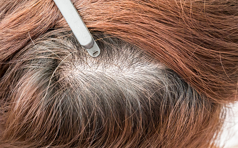 Close-up of a female scalp showing visible hair thinning.