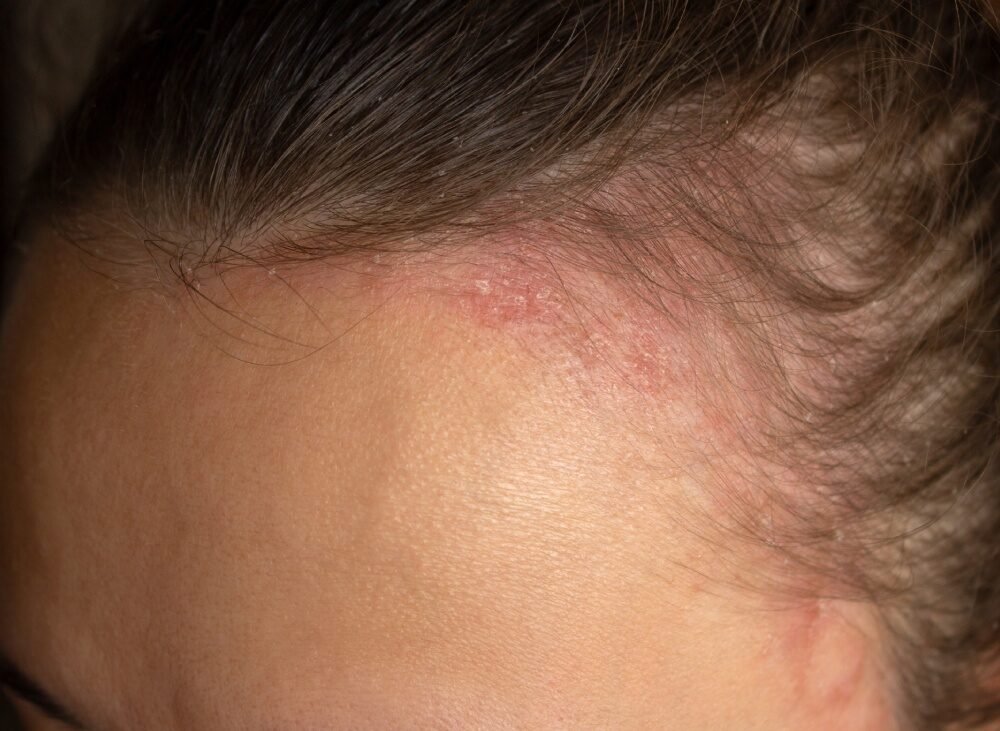 woman with bump on her forehead