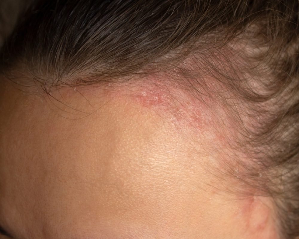 woman with bump on her forehead