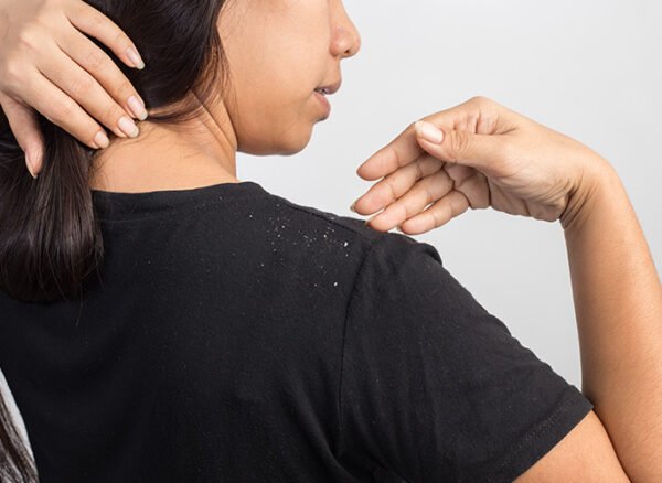 Woman pointing at dandruff flakes on her black t-shirt.