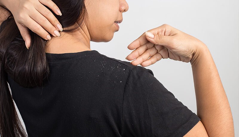 Woman pointing at dandruff flakes on her black t-shirt.