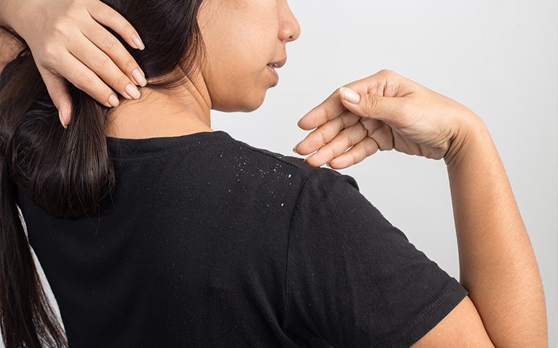 Woman pointing at dandruff flakes on her black t-shirt.