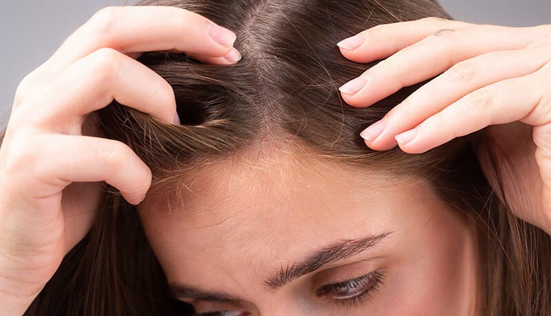 Close-up of woman inspecting her hairline and dry scalp.