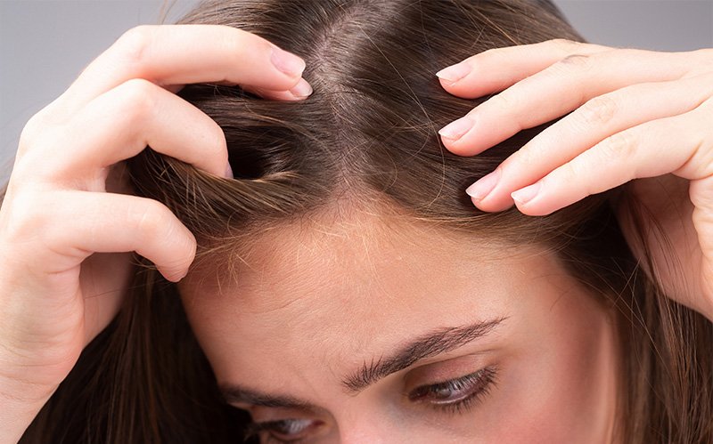 Close-up of woman inspecting her hairline and dry scalp.