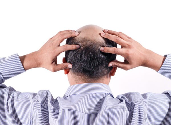 man-holding-back-of-head-revealing-bald-spots-and-hair-thinning-on-crown man-holding-back-of-head-revealing-bald-spots-and-hair-thinning-on-crown