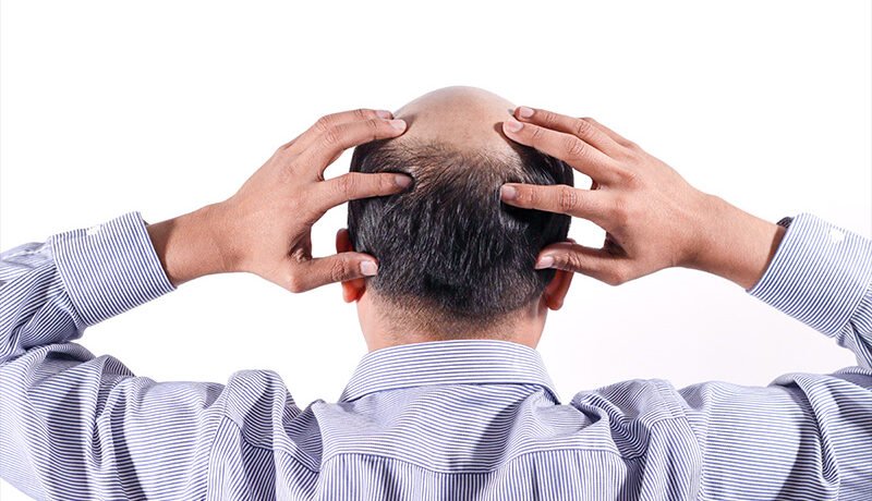 man-holding-back-of-head-revealing-bald-spots-and-hair-thinning-on-crown