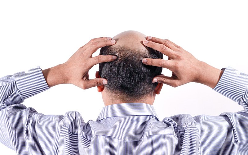man-holding-back-of-head-revealing-bald-spots-and-hair-thinning-on-crown man-holding-back-of-head-revealing-bald-spots-and-hair-thinning-on-crown