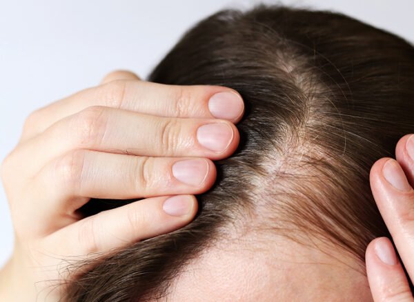 Close-up-of-woman-examining-scalp-for-hair-thinning-concerns Close-up-of-woman-examining-scalp-for-hair-thinning-concerns
