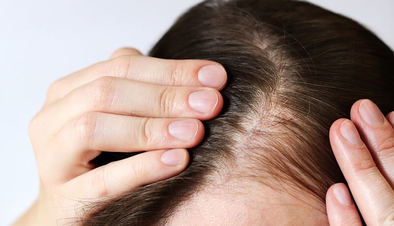 Close-up-of-woman-examining-scalp-for-hair-thinning-concerns