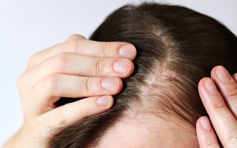 Close-up-of-woman-examining-scalp-for-hair-thinning-concerns Close-up-of-woman-examining-scalp-for-hair-thinning-concerns