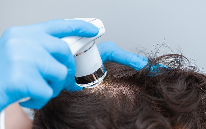 Trichologist-using-microscopic-scanner-to-examine-tender-scalp-issues.