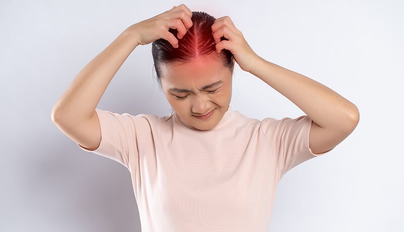Woman-scratching-itchy-and-tender-red-scalp-in-pain.