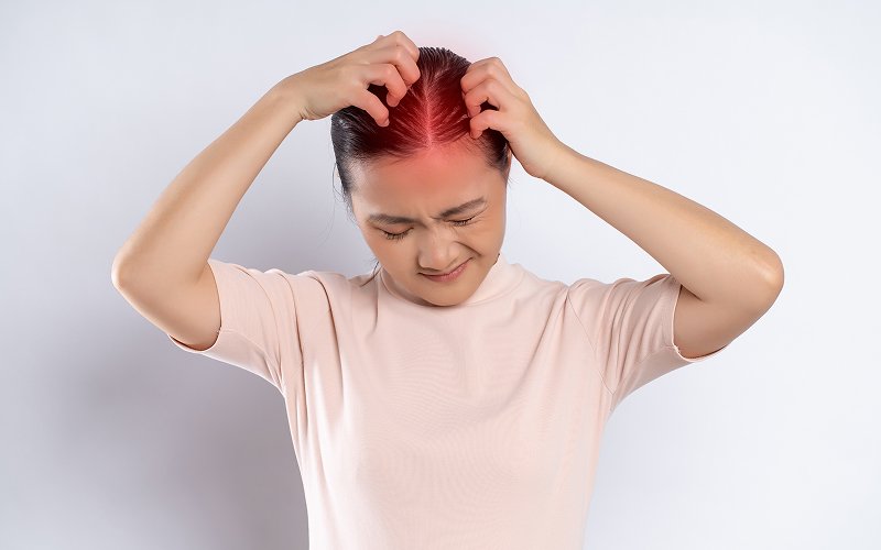 Woman-scratching-itchy-and-tender-red-scalp-in-pain.