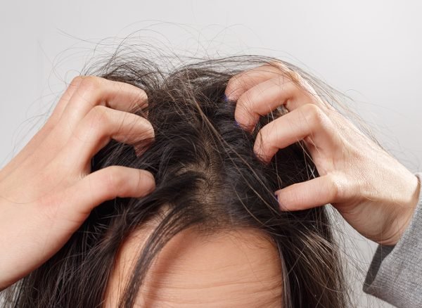 Woman-scratching-oily-and-itchy-scalp-needing-proper-management