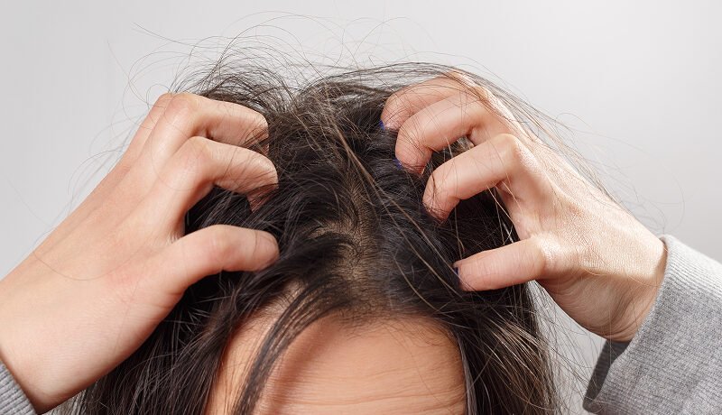 Woman-scratching-oily-and-itchy-scalp-needing-proper-management