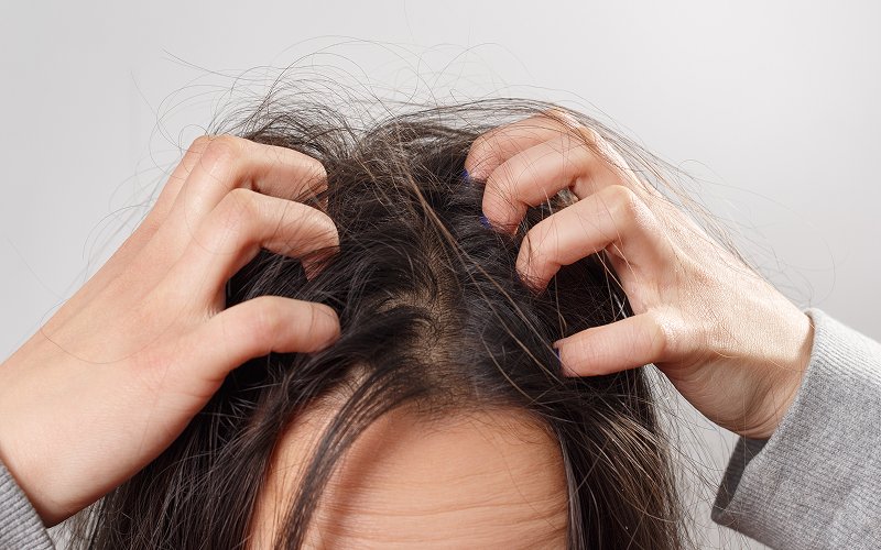 Woman-scratching-oily-and-itchy-scalp-needing-proper-management
