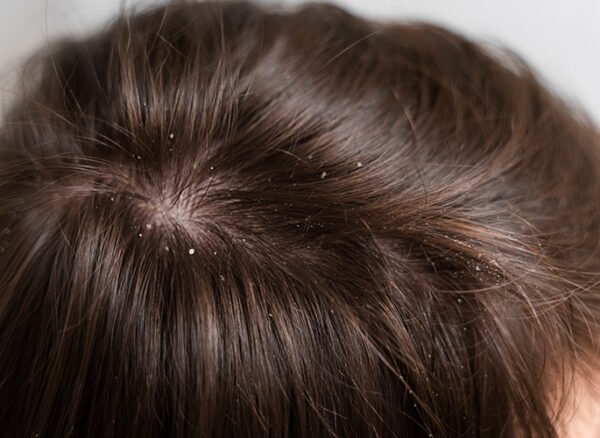 close-up-dandruff-flakes-on-hair-and-scalp close-up-dandruff-flakes-on-hair-and-scalp