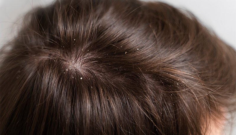 close-up-dandruff-flakes-on-hair-and-scalp