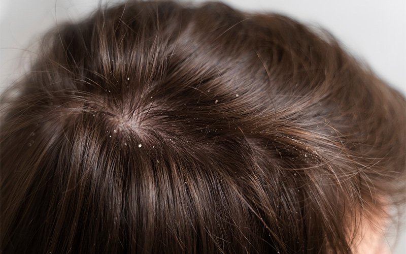 close-up-dandruff-flakes-on-hair-and-scalp