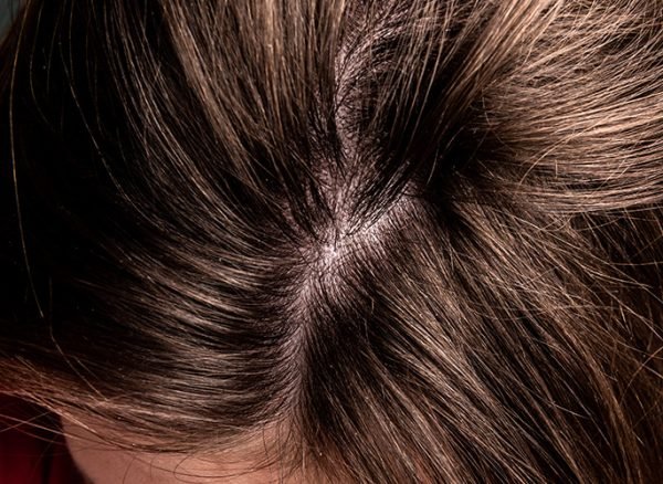 close-up-of-dandruff-flakes-on-brown-hair