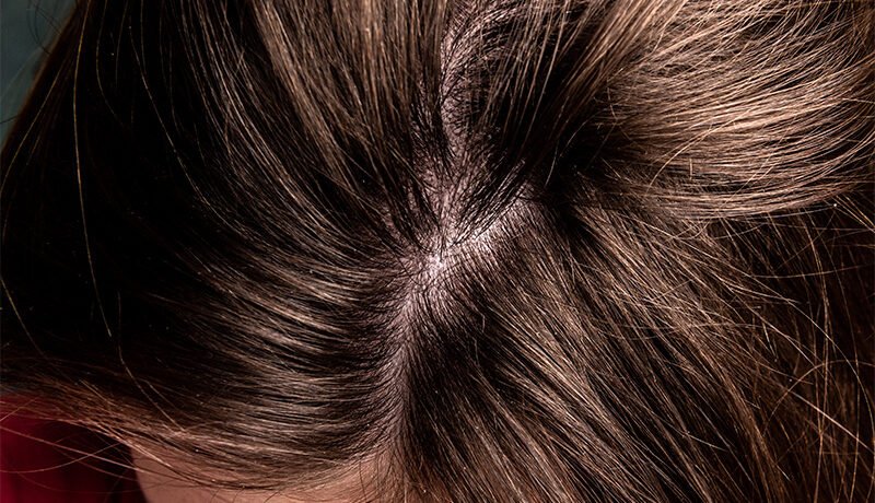 close-up-of-dandruff-flakes-on-brown-hair