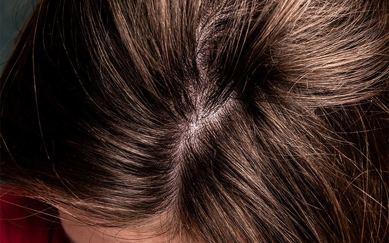 close-up-of-dandruff-flakes-on-brown-hair