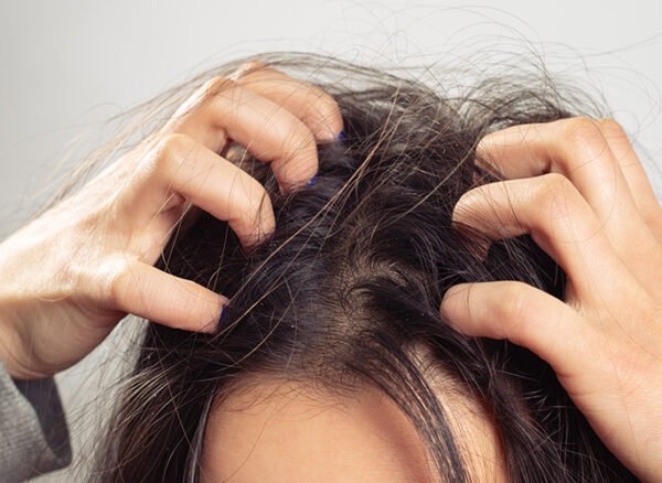 person-scratching-itchy-scalp-dandruff