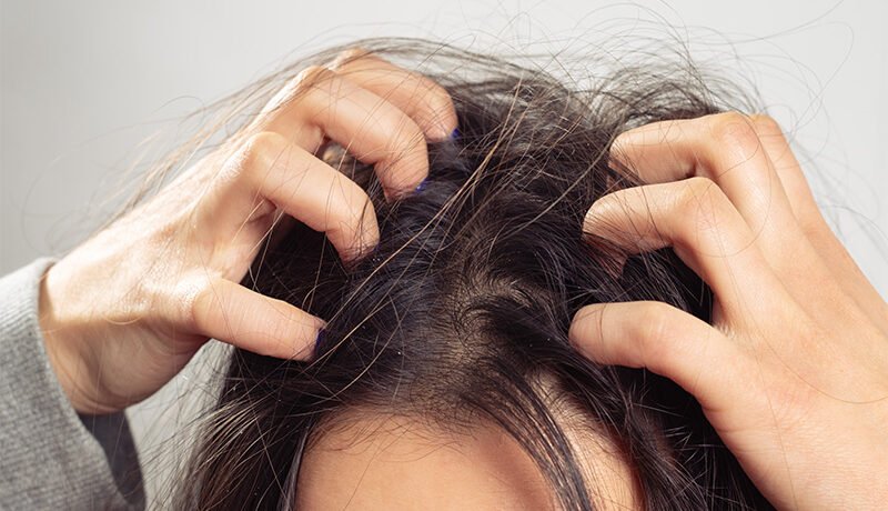 person-scratching-itchy-scalp-dandruff