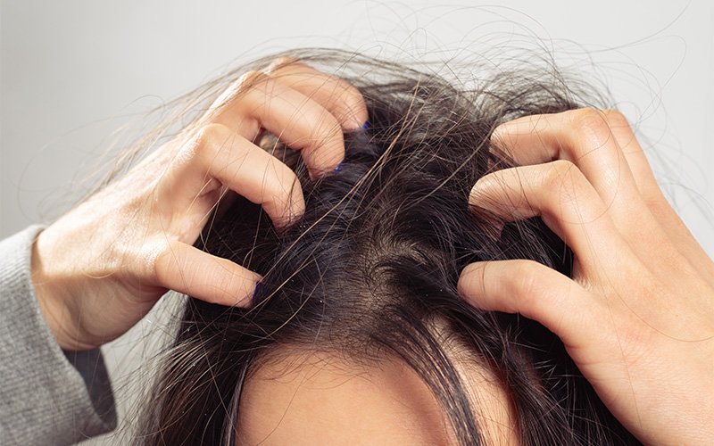 person-scratching-itchy-scalp-dandruff