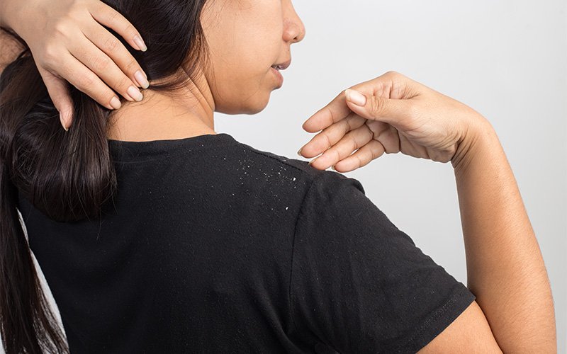 woman-pointing-to-dandruff-flakes-on-shoulder