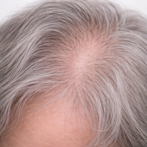 Common Scalp Concerns - Ageing Hair Loss