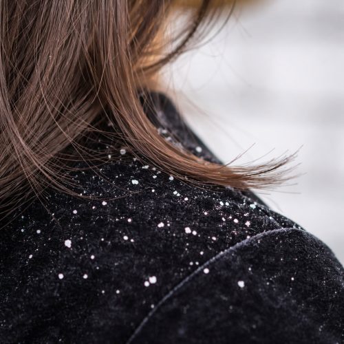 Common Scalp Concerns-Dandruff Flaking (light only)