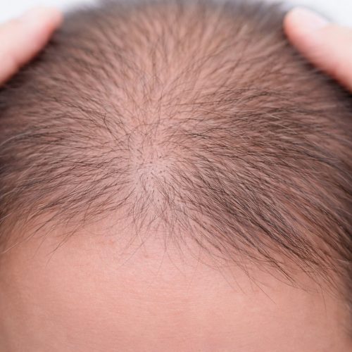 Common Scalp Concerns- Early Hair Loss