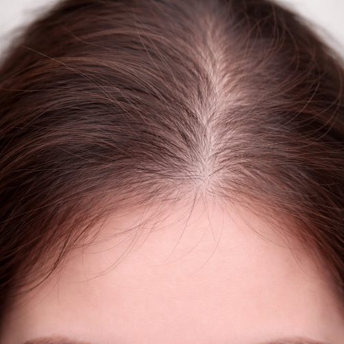 Common Scalp Concerns-Postpartum hair Loss