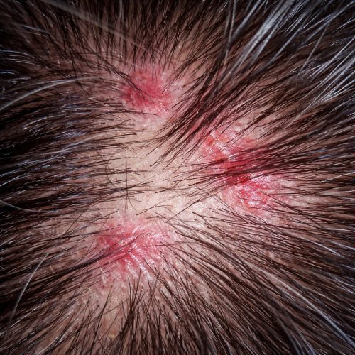 Common Scalp Concerns-Sensitive Irritated Scalp