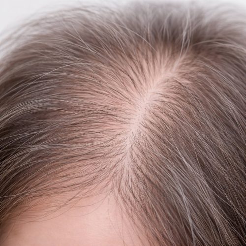 Common Scalp Concerns- Thinning Hair