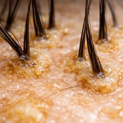 Common Scalp Conerns-Oily Congested Scalp